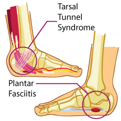 What is Plantar Fasciitis and the Tarsal Tunnel Syndrome