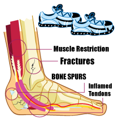 Starting point of Plantar Fasciitis and Tarsal Tunnel Syndrome