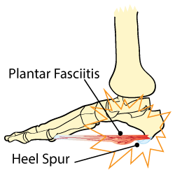 Plantar Fasciitis Vs Heel Spurs