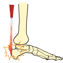 What is Achilles Tendonitis?