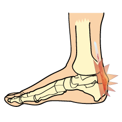 Achilles Tendonitis Symptoms