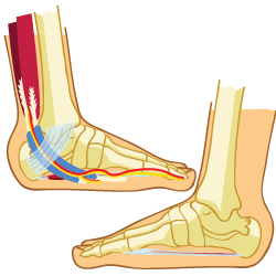 Plantar Fasciitis vs Tarsal Tunnel