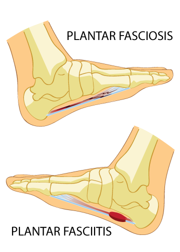 Plantar Fasciosis vs. Plantar Fasciitis