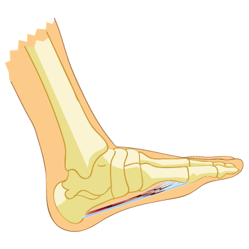 What is Plantar Fasciosis?