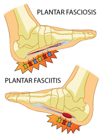 Plantar Fasciitis Vs Plantar Fasciosis